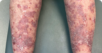 Plaque Psoriasis on Lower Legs at Baseline