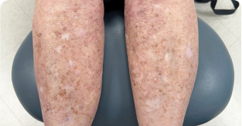 Plaque Psoriasis on Lower Legs by Week 24 of Sotyktu Treatment