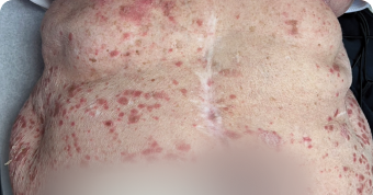 Plaque Psoriasis on Abdomen at Baseline