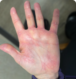 Plaque Psoriasis on Palm at Baseline