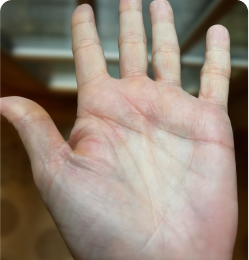 Plaque Psoriasis on Palm by Week 24 Sotyktu Treatment