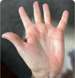 Plaque Psoriasis on Palm by Week 16 of Sotyktu Treatment