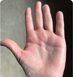 Plaque Psoriasis on Palm by Week 52 of Sotyktu Treatment