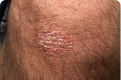 Plaque Psoriasis on Knee at Baseline