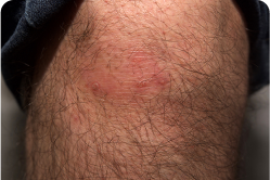 Plaque Psoriasis on Knee by Week 24 Sotyktu Treatment