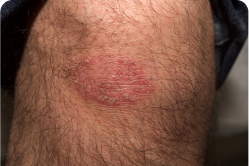 Plaque Psoriasis on Knee by Week 16 of Sotyktu Treatment