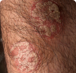 Plaque Psoriasis on Lower Leg at Baseline