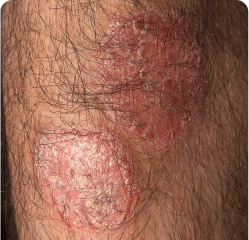 Plaque Psoriasis on Lower Leg by Week 16 of Sotyktu Treatment