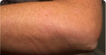 Plaque Psoriasis on Elbow by Week 24 Sotyktu Treatment